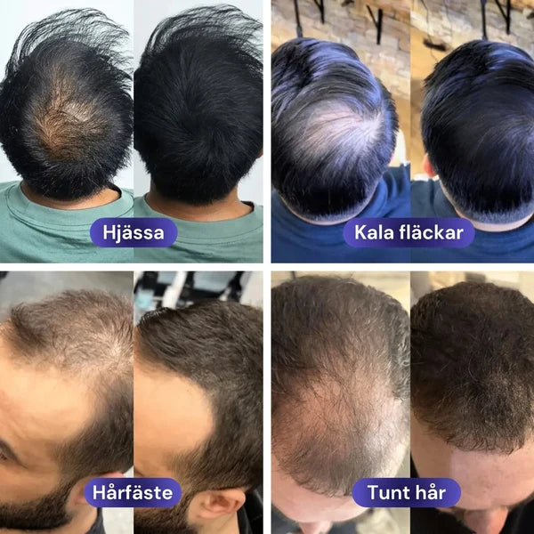 Hårlyft för män – Ingen märker skillnaden